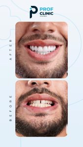 The Best Cost Hollywood Smile in Istanbul Turkey - Prof Clinic Istanbul