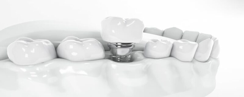 Is it Safe To Have Dental Implants in Turkey?