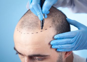 10 reasons to choose the best hair transplantation in Istanbul?