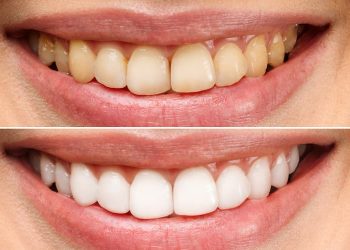 3 Types of Hollywood Smile in Istanbul