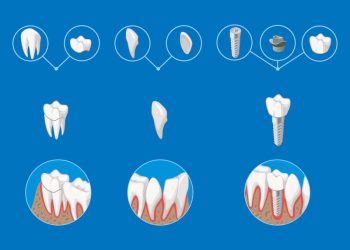 Why are Emax crowns the best for dental implants?