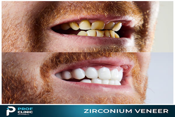 Top Dental Implant Clinic in Istanbul, Turkey-Prof Clinic Istanbul