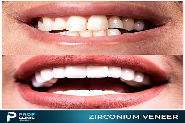 Zirconia Dental Implants in Turkey - Prof Clinic Istanbul