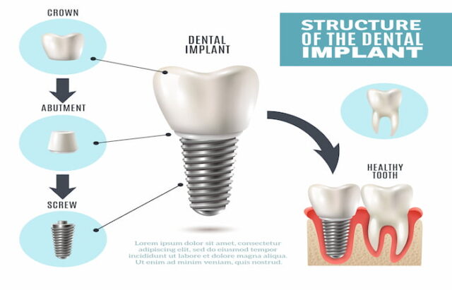 Safe To Have Dental Implants in Turkey - Prof clinic Istanbul