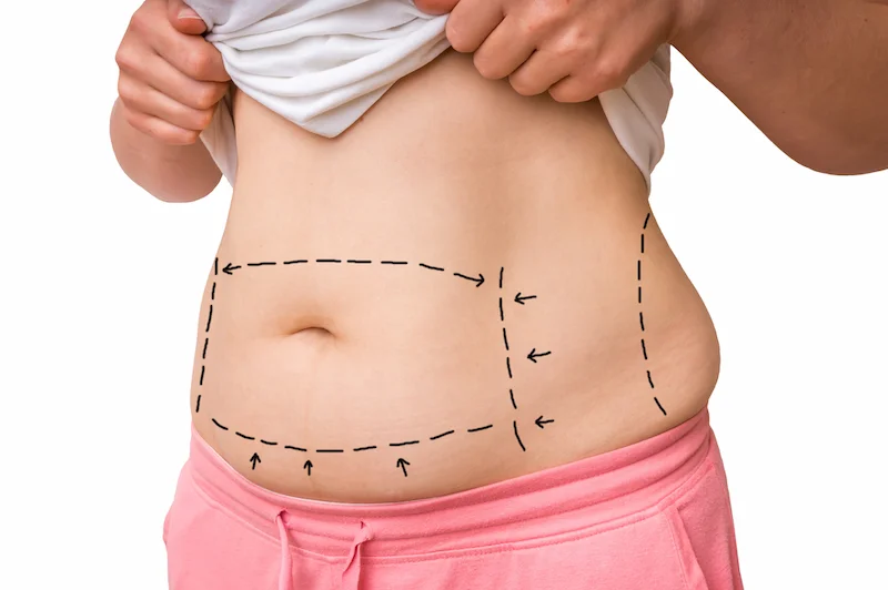 What are the Differences Between Liposuction and Tummy Tuck in Turkey?