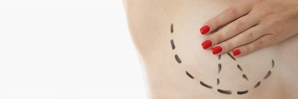 Female breasts with black marker markers for breast reduction surgery