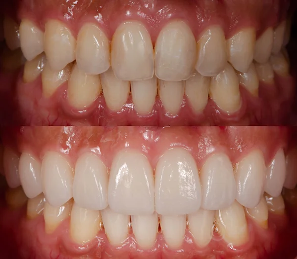 Dental ceramic veneer covering for improve color and shape of teeth - Prof Clinic
