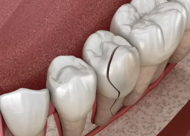 Cracked, split teeth treated through veneers - Prof Clinic