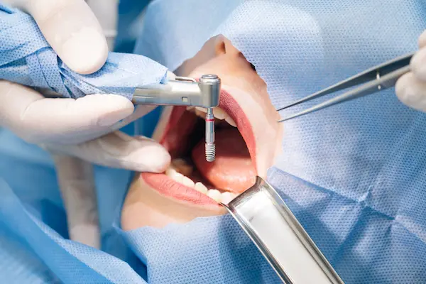 Dental Implant Installation Procedure