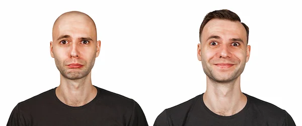 bald man before and after a successful hair transplant surgery