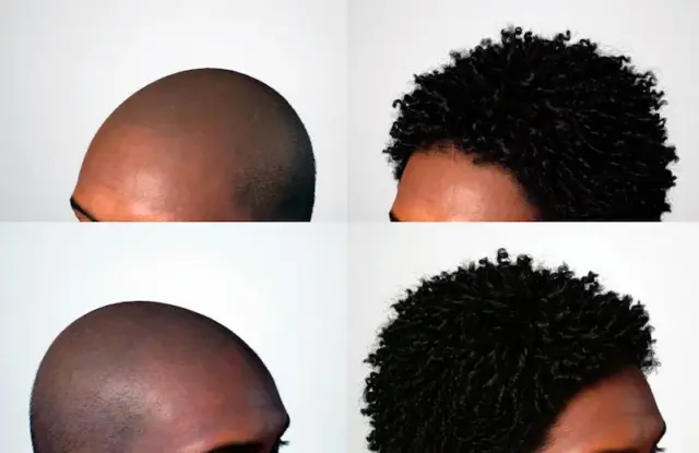 USA hair transplant hair before and after