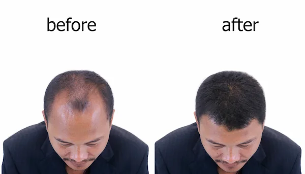  before and after hair transplant photo of a man.