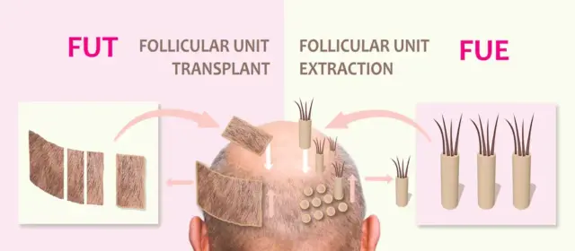 hair Transplant Techniques: FUE VS FUT