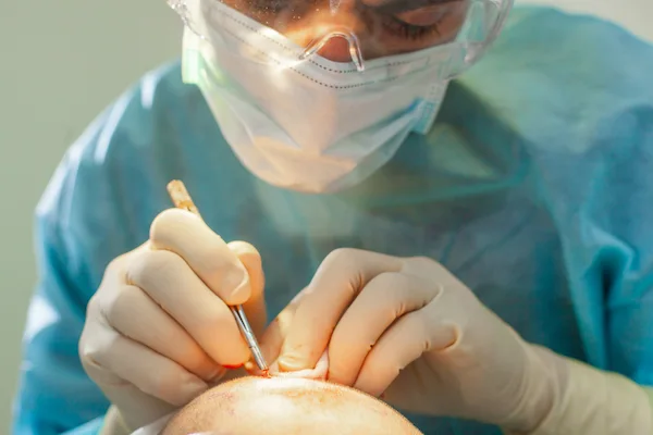  Hair Transplant in Turkey: The Pros & Cons