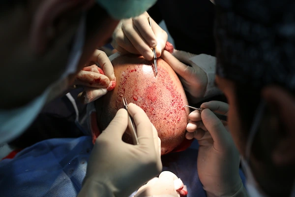 Preparation for a Male Hair Transplant Procedure
