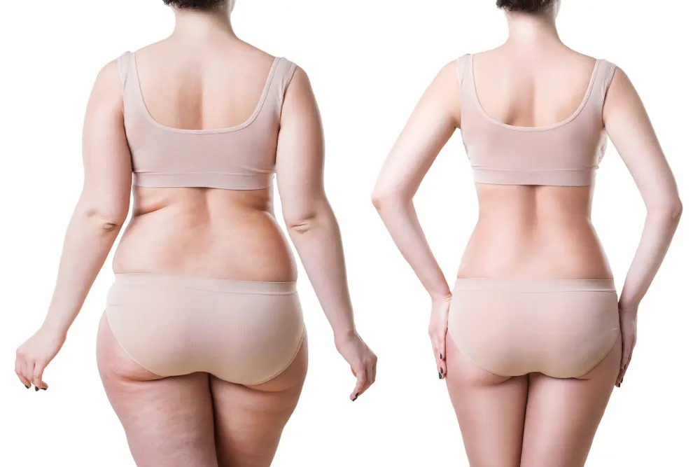 Common Reasons For Considering Liposuction Procedure