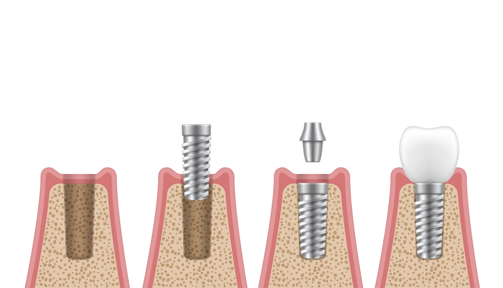 A dental implant is a system designed to replace a missing tooth, Prof Clinic Provides you with the best dental implant in Turkey.