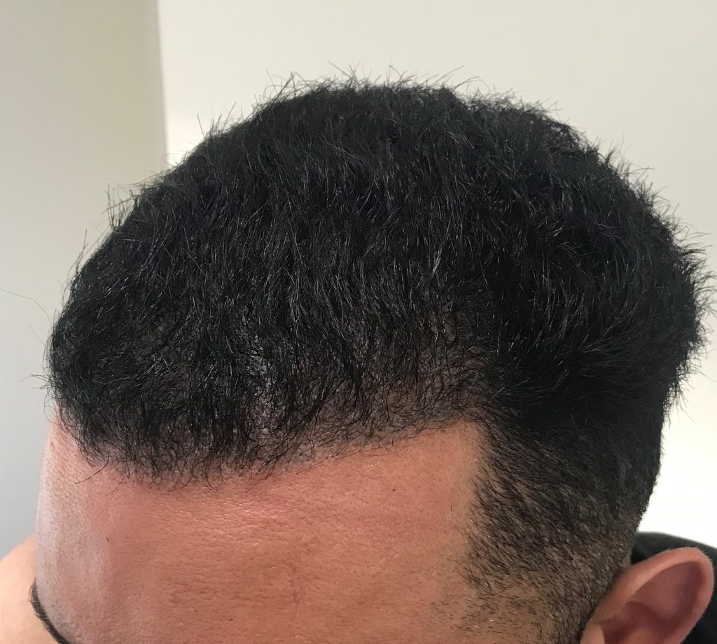 Afro Hair Transplant in Turkey​