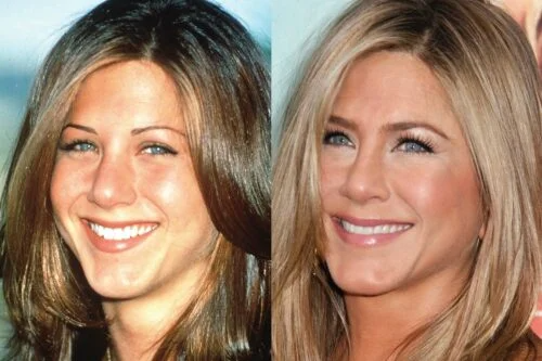 Jennifer Aniston Plastic Surgery