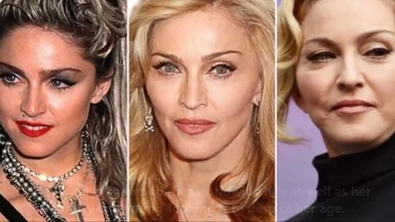 Madonna Before and After Plastic Surgery