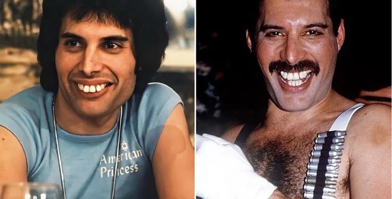 Freddie Mercury’s Teeth: The Iconic Smile He Never Fixed and Why