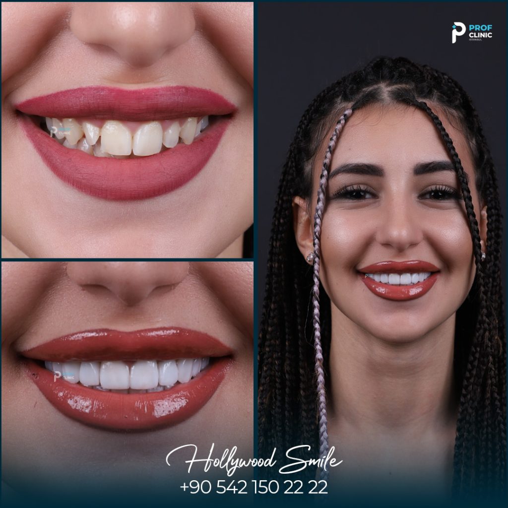 Dental Implants Turkey