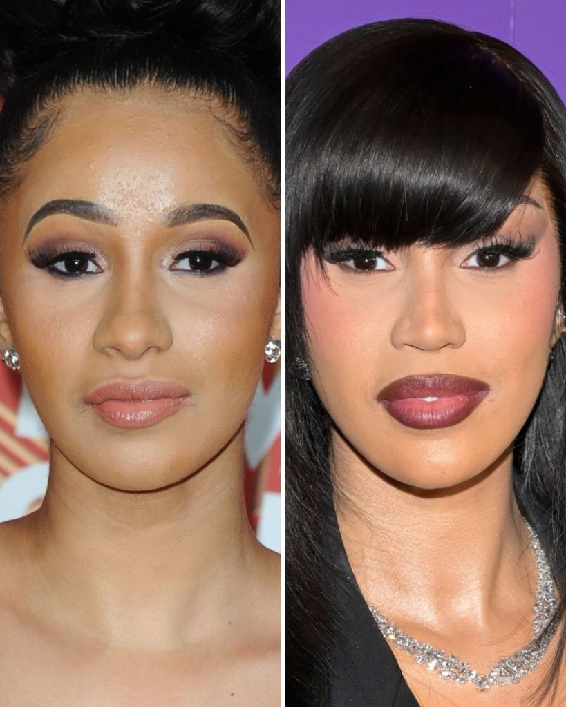 Cardi B plastic surgery