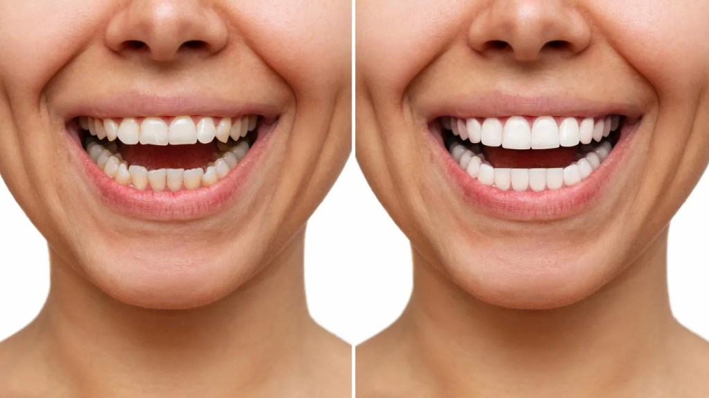 Porcelain Veneers Cost