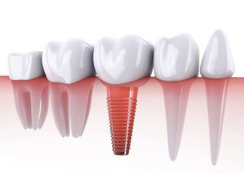 Are Turkey Teeth Safe? A Complete Guide to Veneers and Dental Implants in Turkey