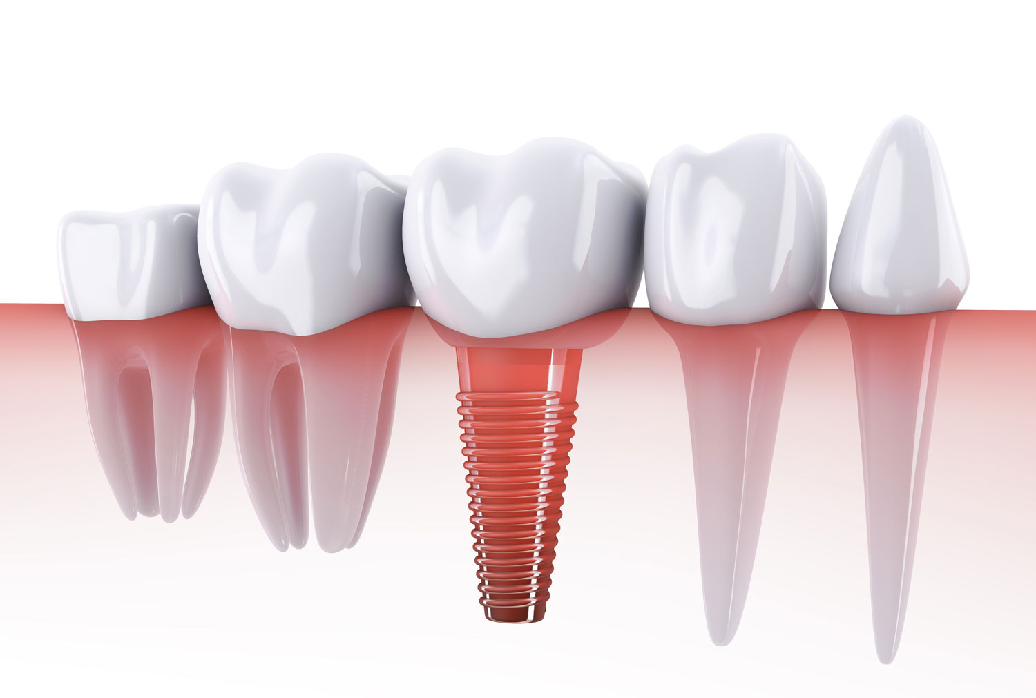 Are Turkey Teeth Safe? A Complete Guide to Veneers and Dental Implants in Turkey