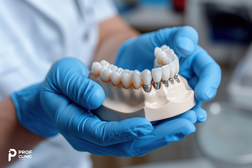 The Costs of Full Mouth Dental Implants