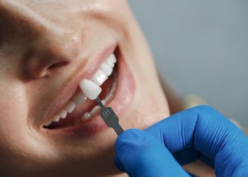 Veneers Without Shaving Teeth: Pros, Cons, and Alternatives