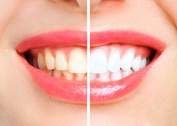 Are Yellow Teeth Stronger Than White Teeth?