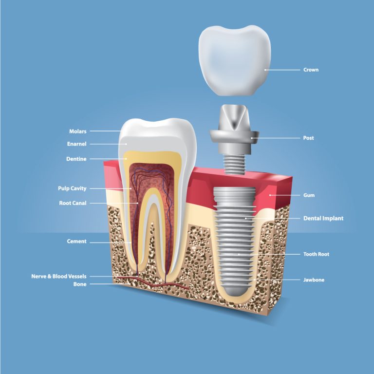 Cost of Dental Crown Repair What Influences the Price?