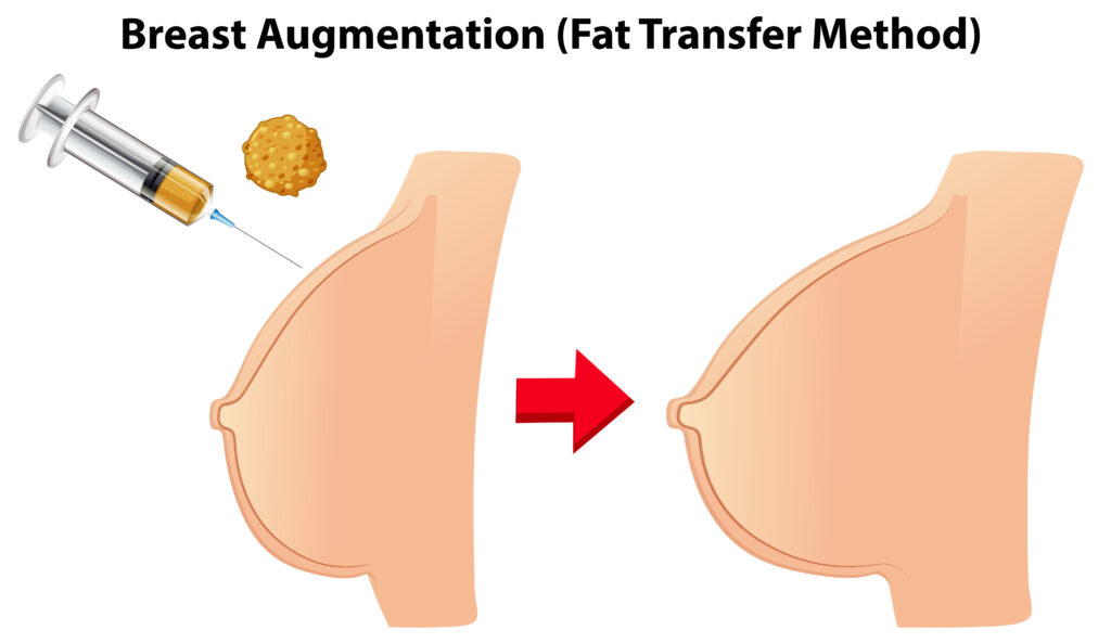 Fat Transfer Breast Augmentation