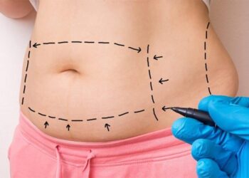 Is It Safe to Have a Tummy Tuck in Turkey? Costs, Benefits, and What to Expect