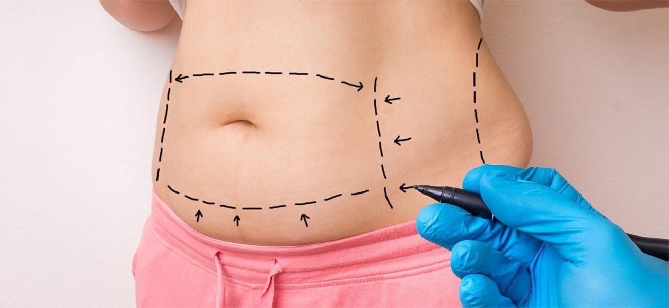 Is It Safe to Have a Tummy Tuck in Turkey? Costs, Benefits, and What to Expect