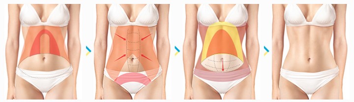 Tummy Tuck Cost