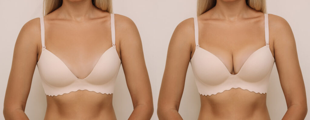 Benefits of Breast Implants: Enhancing Confidence and Aesthetics