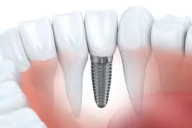 Define Dental Implant: Comprehensive Guide