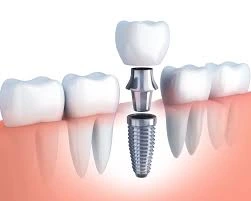 What do dental implants look like?