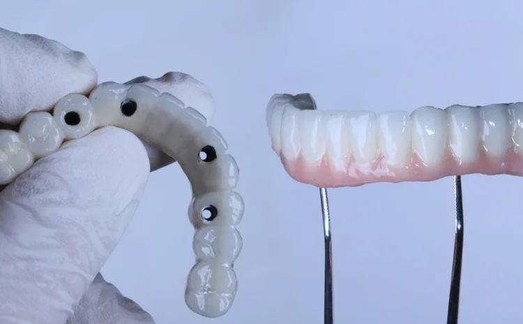 All-on-4 Dental Implants in Turkey: Cost & Advantages