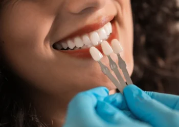 Types of Dental Veneers and the Best Options with Prices