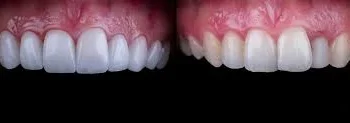 Feldspathic vs Emax Veneers: A Complete Guide for 2025