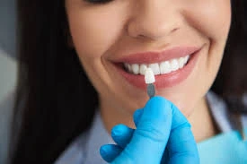 What is a Hollywood smile?