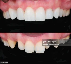 What is a Bollywood smile?