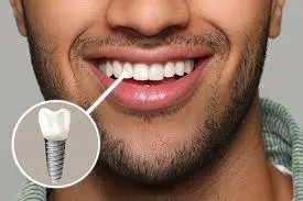 The importance of dental implants