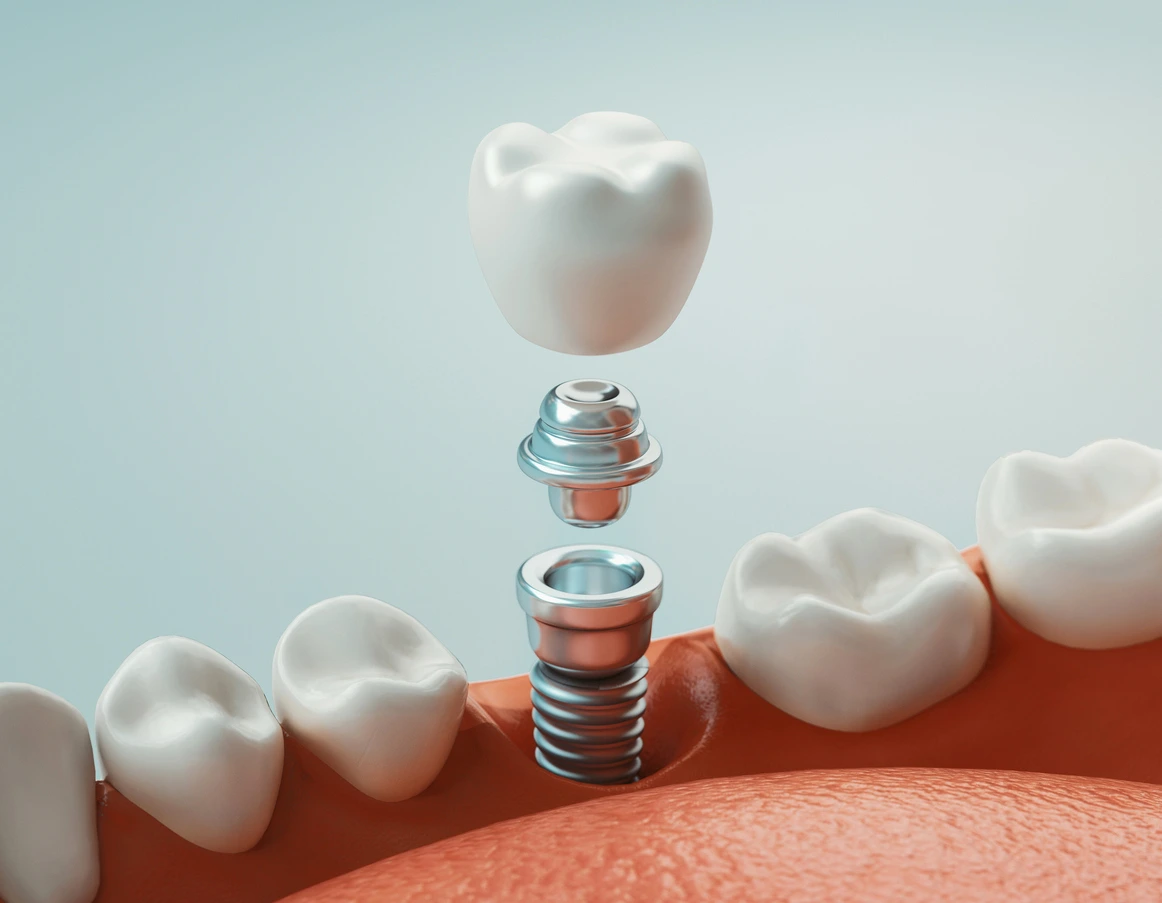 Components of Dental Implants