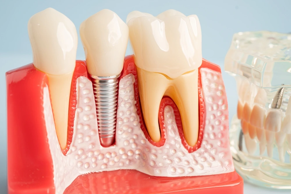 Information About Dental Implants