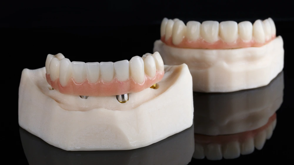 What Are Temporary Veneers?